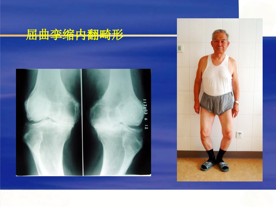 膝关节骨性关节炎的分级治疗_第7页