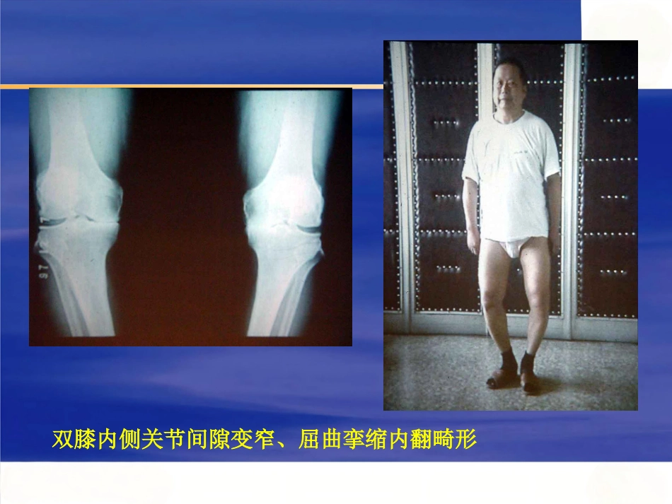 膝关节骨性关节炎的分级治疗_第9页