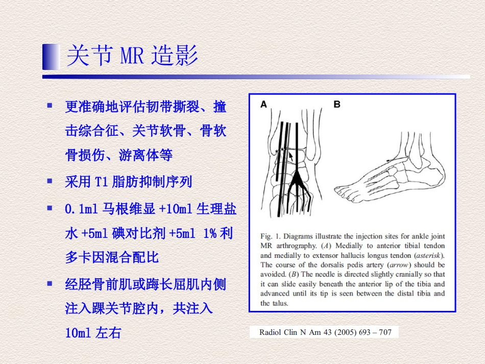 踝关节运动损伤MR诊断价值_第12页