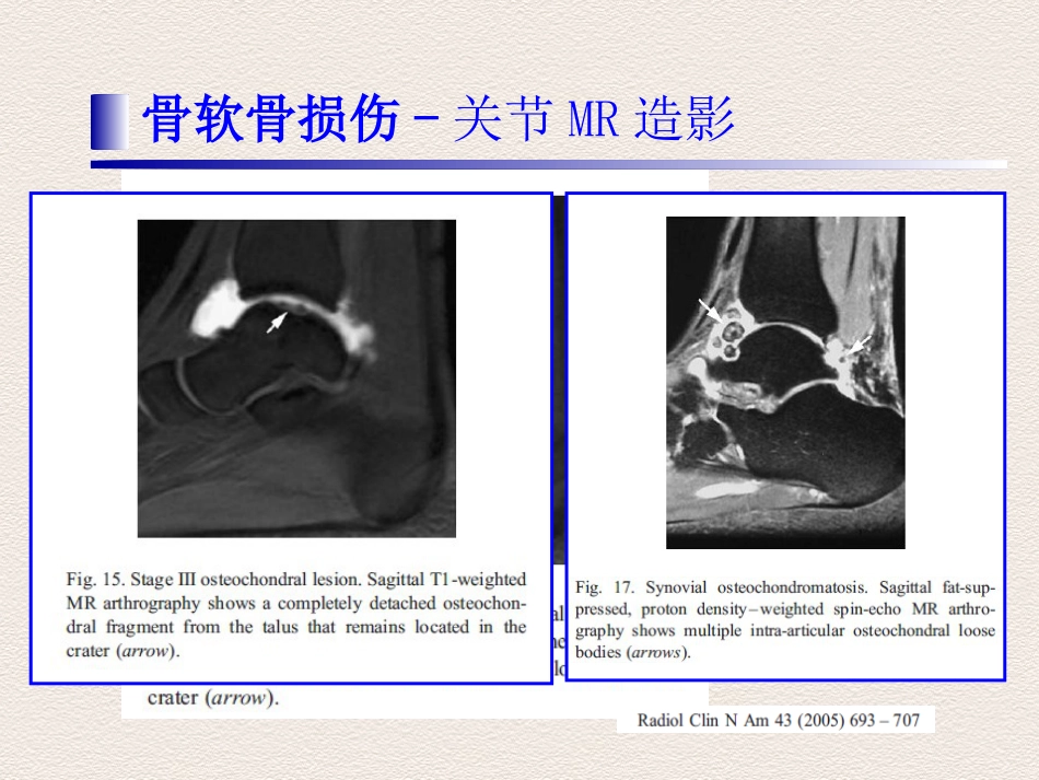踝关节运动损伤MR诊断价值_第13页