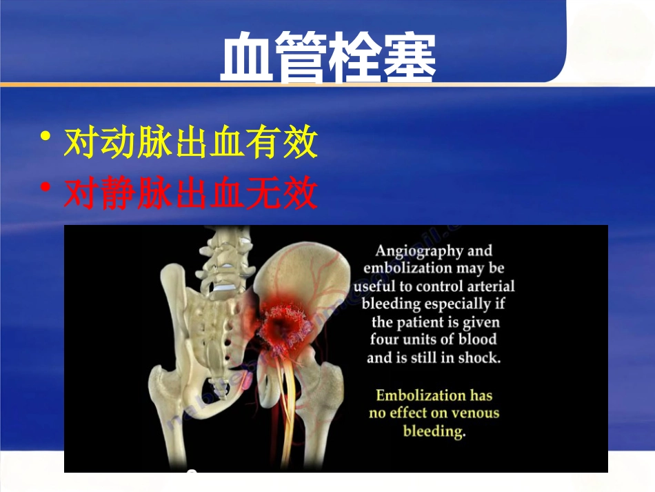 严重骨盆骨折的急救处理_第10页