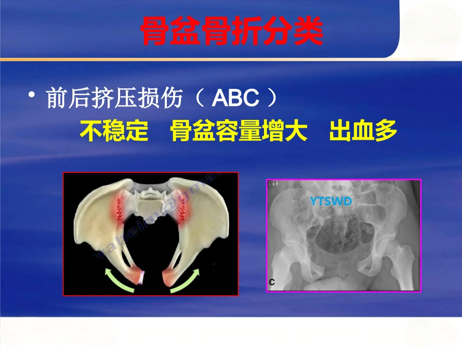 严重骨盆骨折的急救处理_第11页