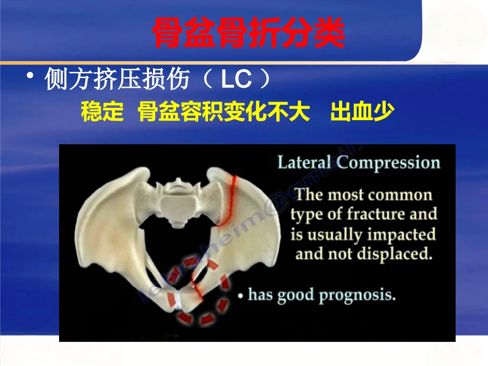 严重骨盆骨折的急救处理_第12页