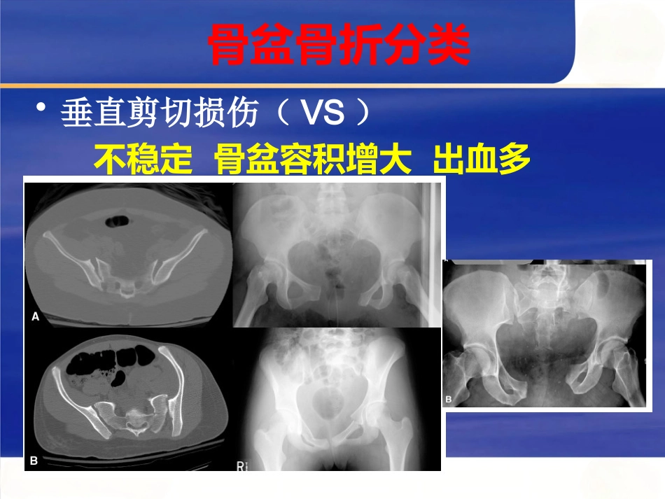 严重骨盆骨折的急救处理_第14页