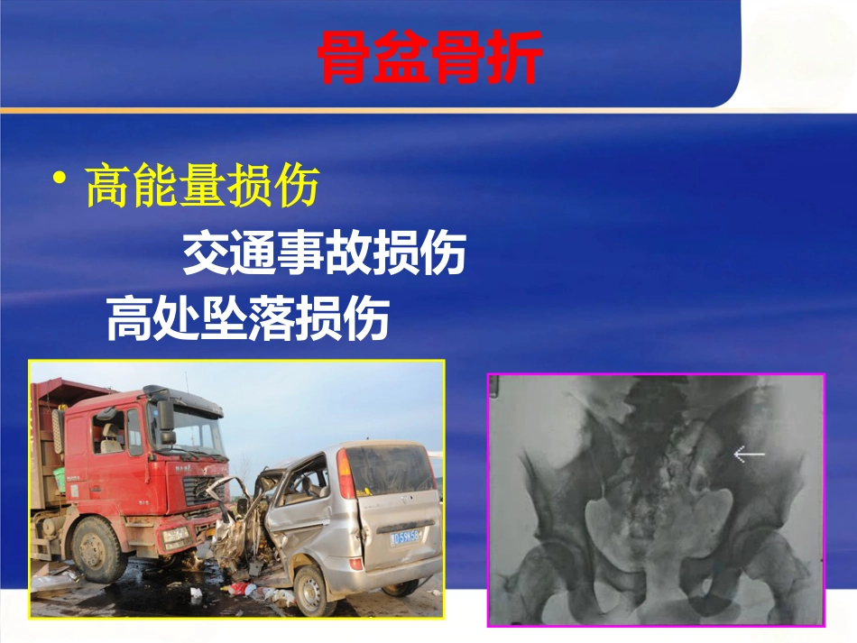 严重骨盆骨折的急救处理_第4页