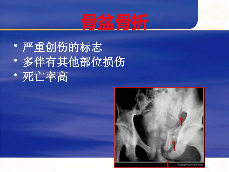 严重骨盆骨折的急救处理_第5页