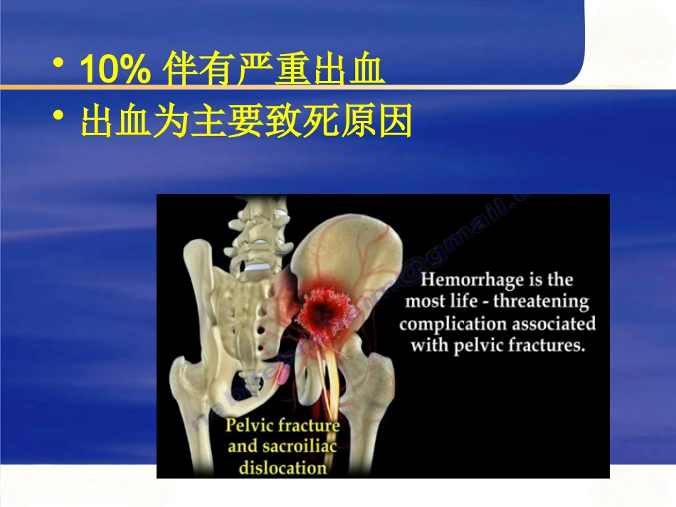 严重骨盆骨折的急救处理_第7页
