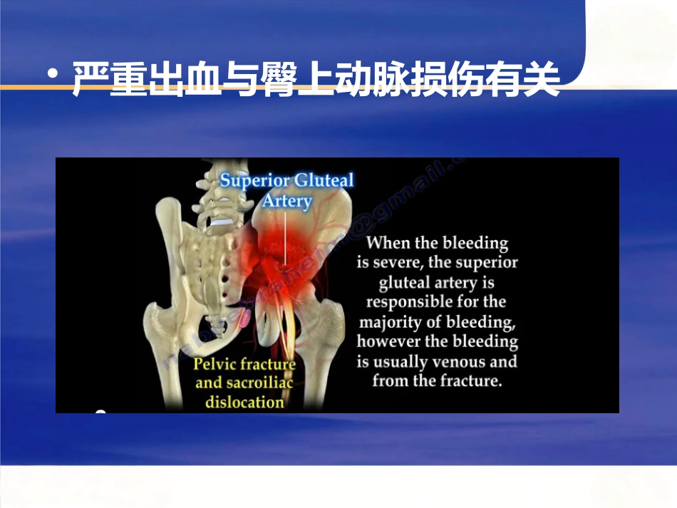 严重骨盆骨折的急救处理_第8页