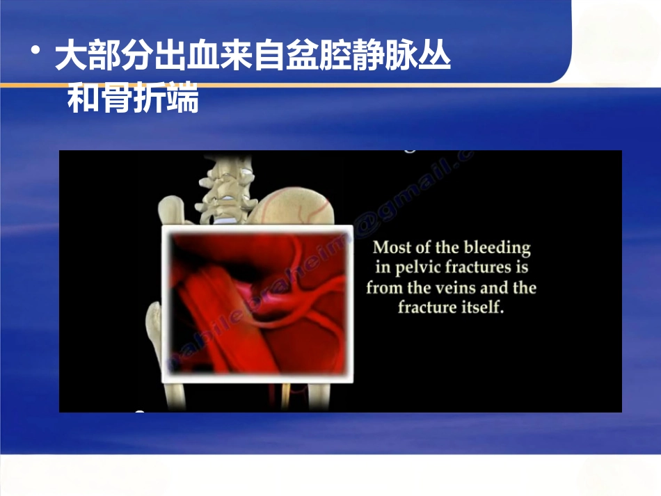严重骨盆骨折的急救处理_第9页