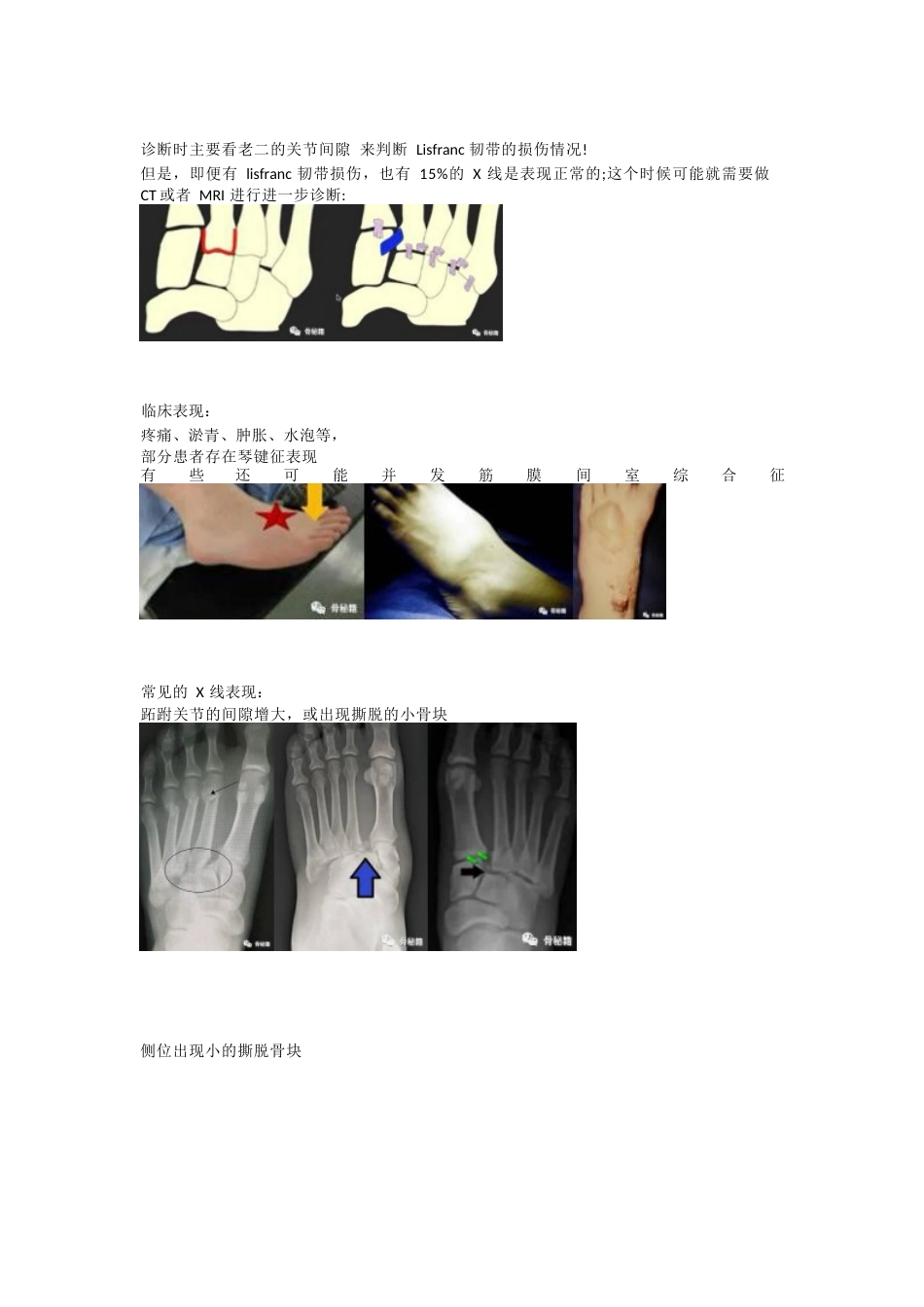 跖跗关节（Lisfranc）损伤的治疗策略与技巧_第3页