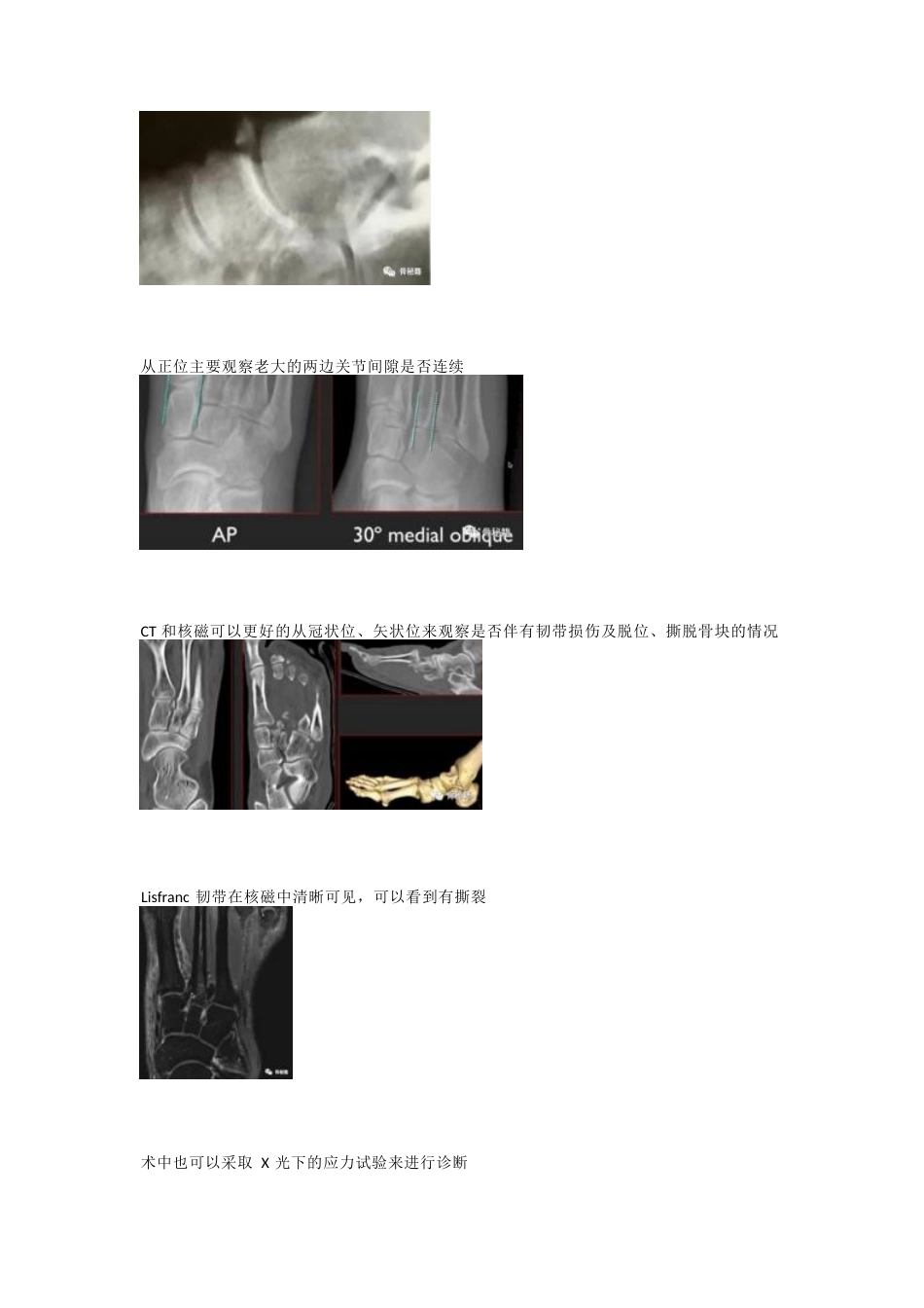 跖跗关节（Lisfranc）损伤的治疗策略与技巧_第4页
