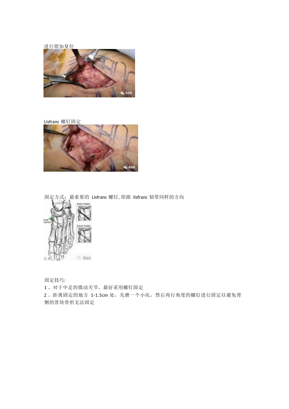 跖跗关节（Lisfranc）损伤的治疗策略与技巧_第7页