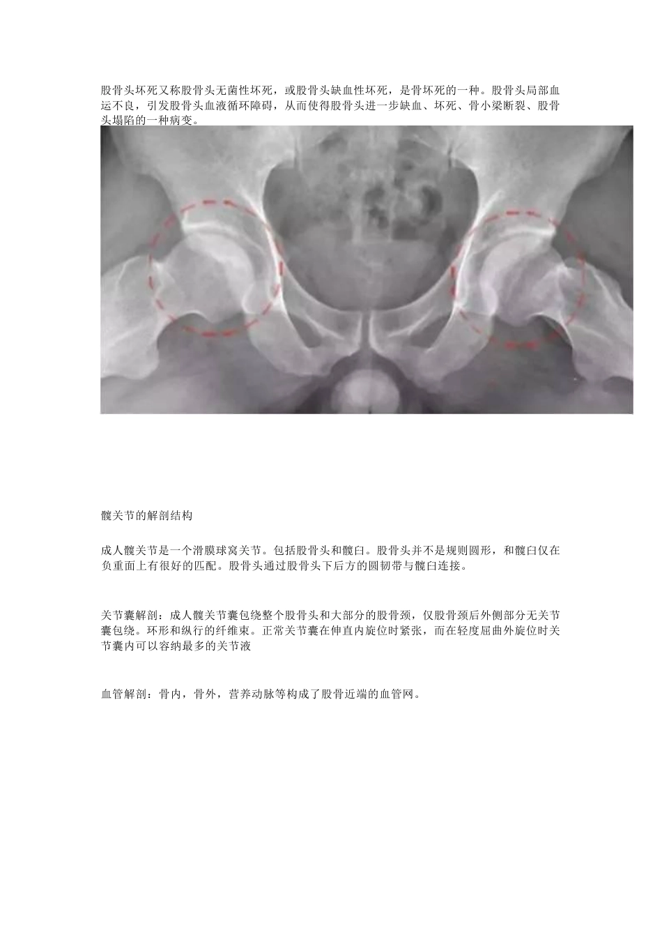 股骨头坏死的诊断与治疗策略_第1页