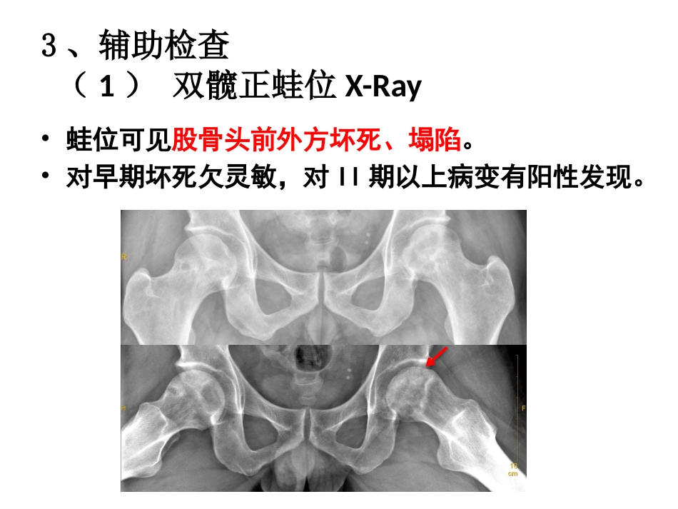 股骨头坏死的诊断及保髋方法的选择_第12页