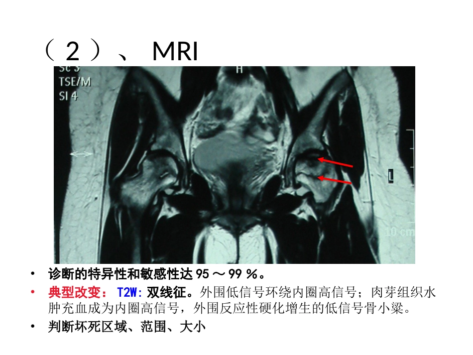 股骨头坏死的诊断及保髋方法的选择_第13页