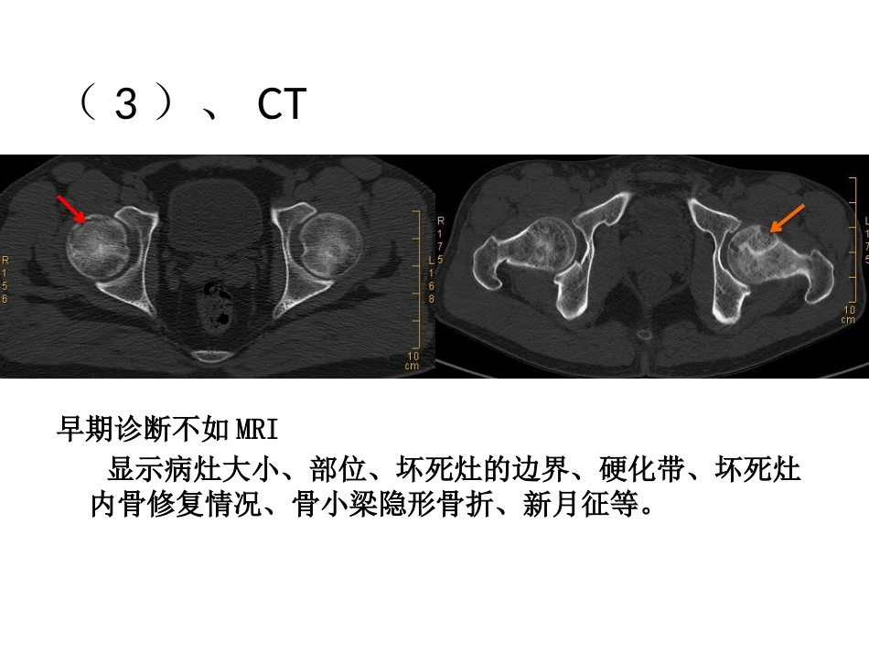 股骨头坏死的诊断及保髋方法的选择_第14页
