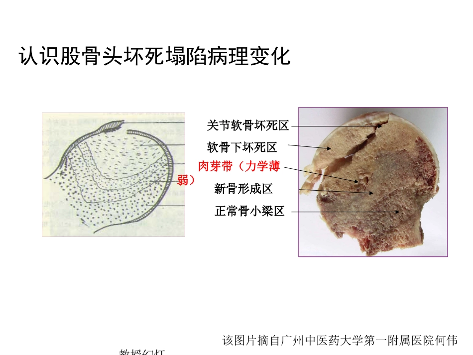 股骨头坏死的诊断及保髋方法的选择_第5页