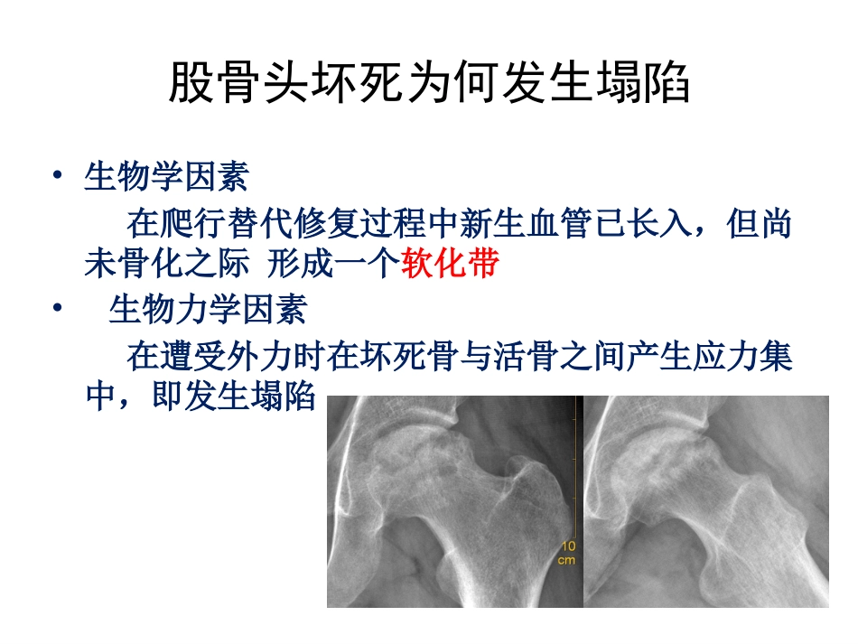 股骨头坏死的诊断及保髋方法的选择_第6页