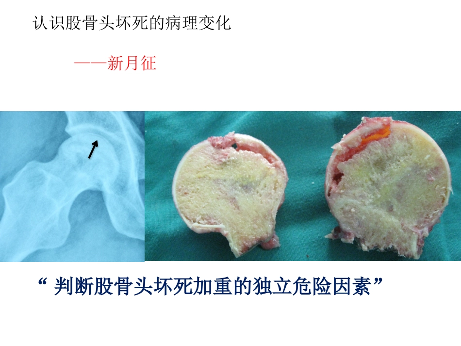股骨头坏死的诊断及保髋方法的选择_第7页