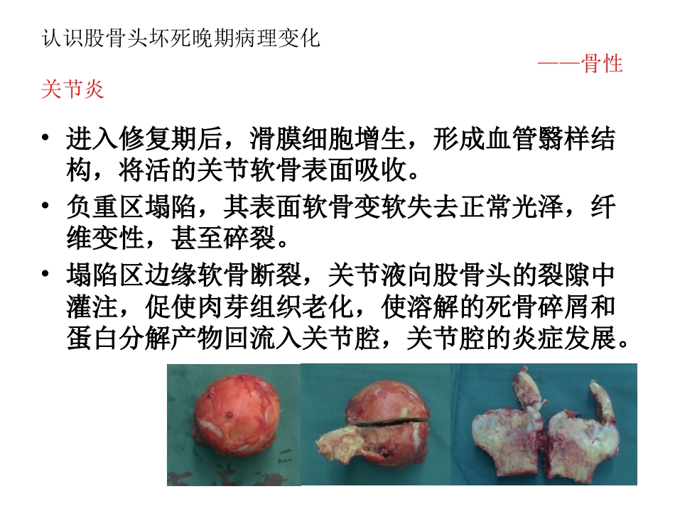 股骨头坏死的诊断及保髋方法的选择_第8页