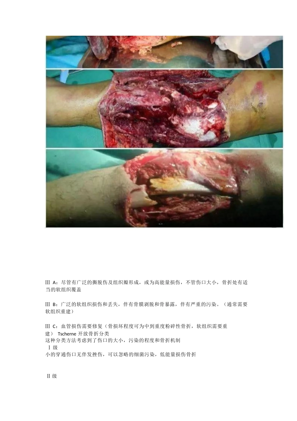 开放性骨折的治疗原则_第6页