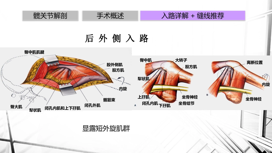 人工全髋关节置换术后脱位_第12页