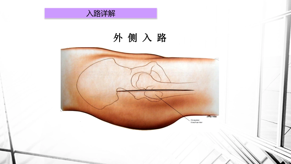 人工全髋关节置换术后脱位_第14页