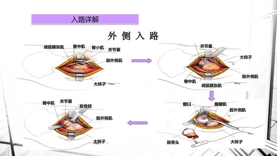 人工全髋关节置换术后脱位_第15页