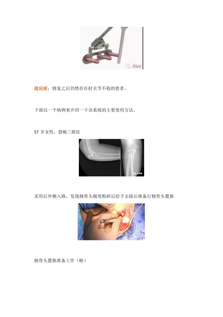 治疗肘关节恐怖三联征新方法_第2页