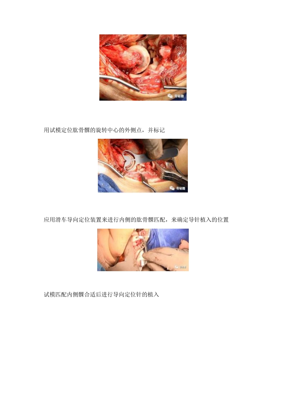 治疗肘关节恐怖三联征新方法_第3页