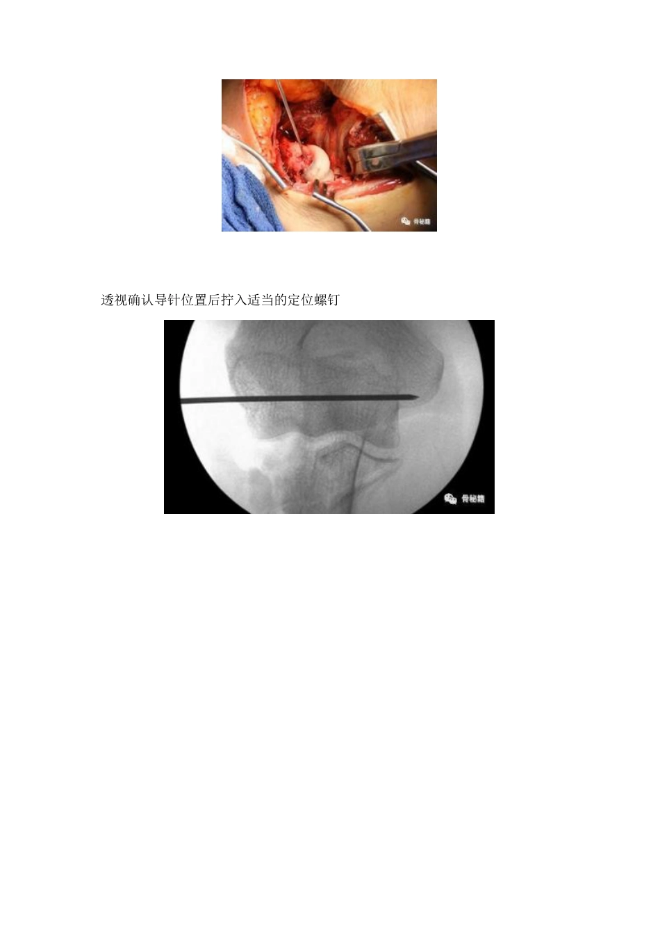 治疗肘关节恐怖三联征新方法_第5页