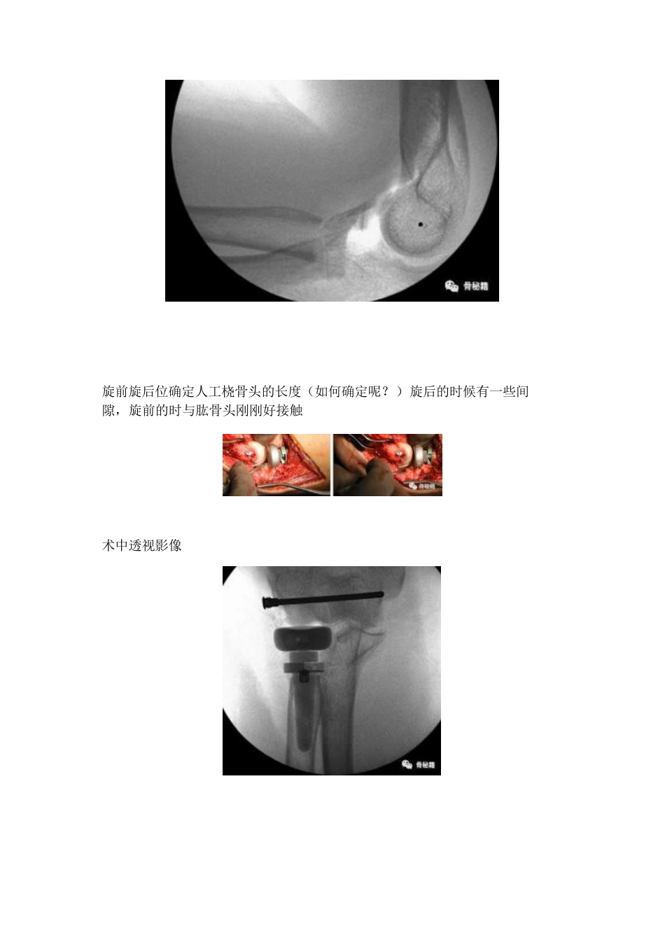 治疗肘关节恐怖三联征新方法_第6页