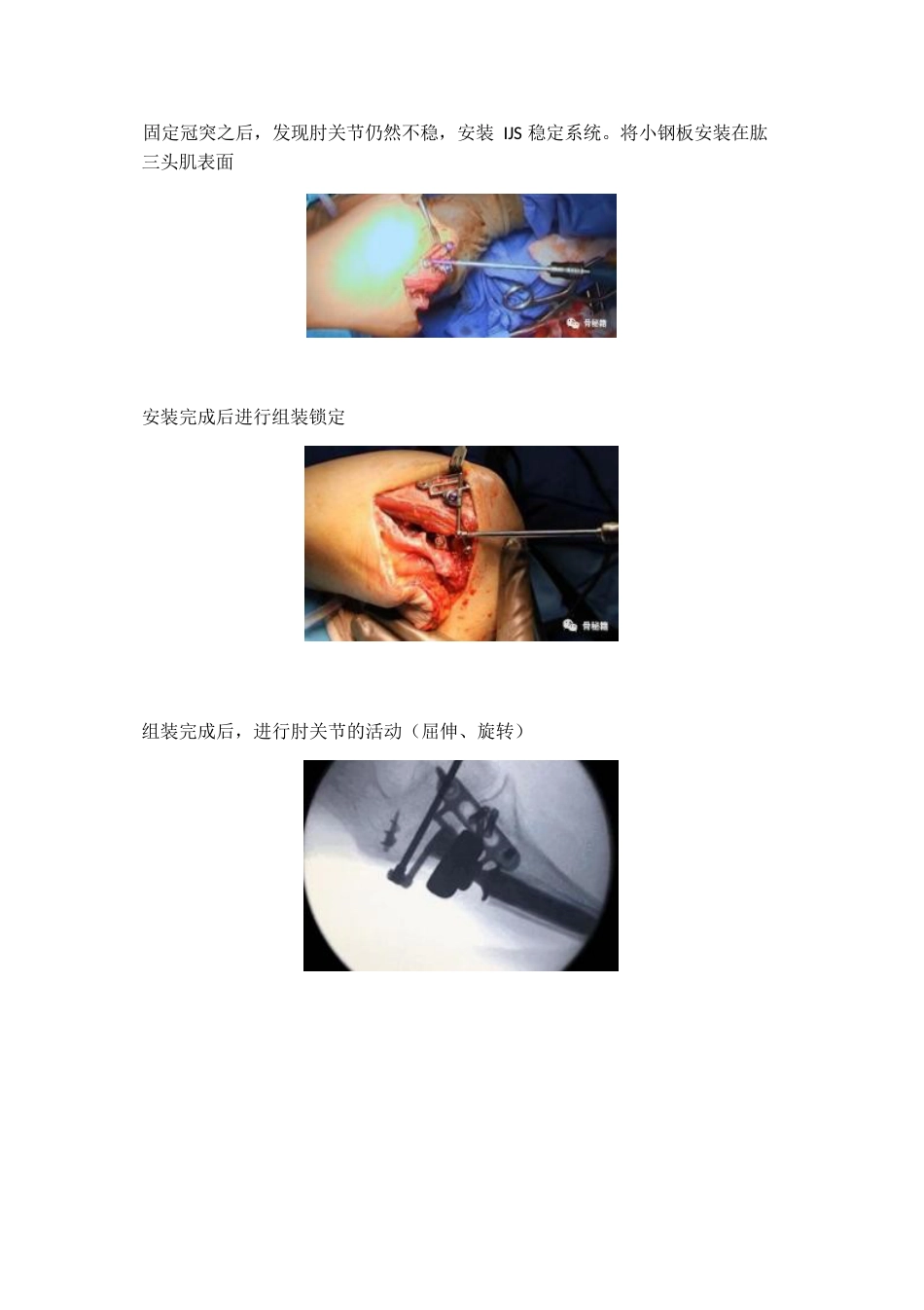 治疗肘关节恐怖三联征新方法_第7页
