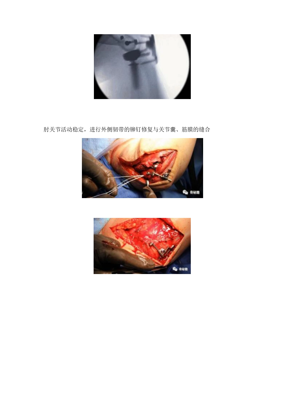 治疗肘关节恐怖三联征新方法_第8页