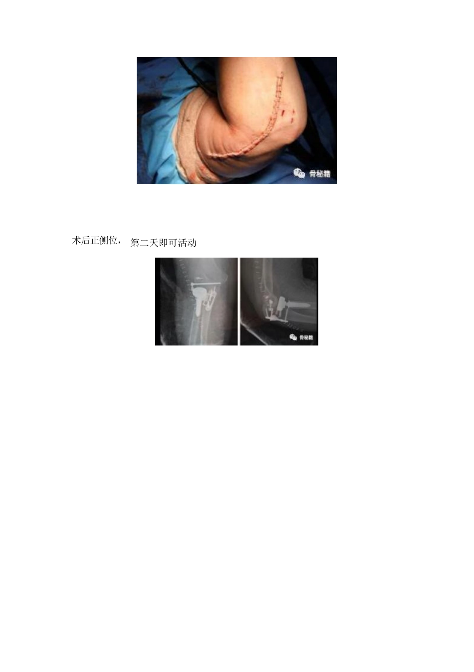 治疗肘关节恐怖三联征新方法_第9页