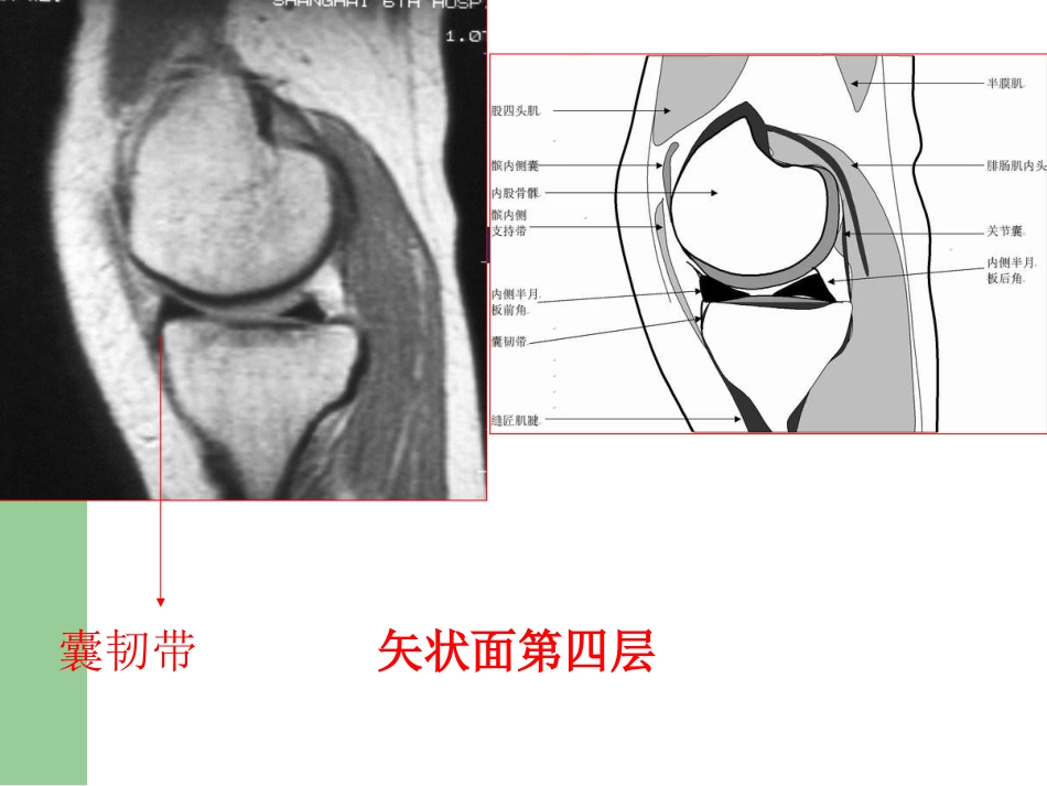 膝关节半月板损伤MRI诊断(ppt)_第11页