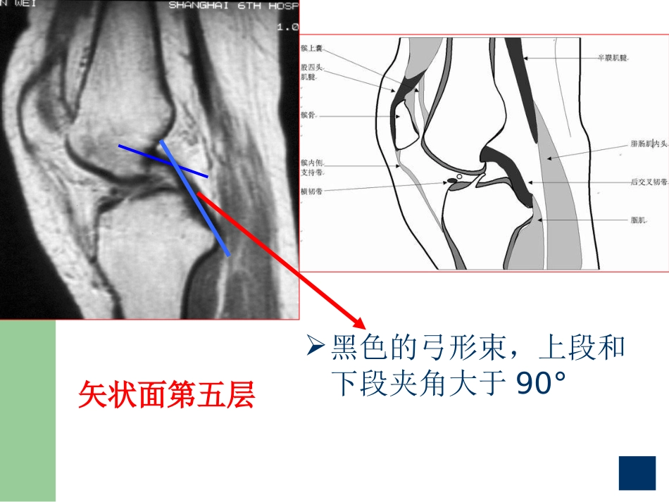 膝关节半月板损伤MRI诊断(ppt)_第12页