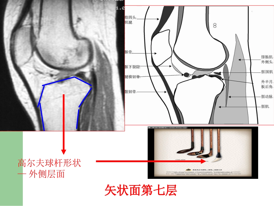 膝关节半月板损伤MRI诊断(ppt)_第14页