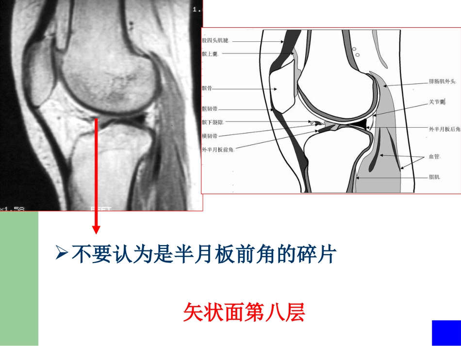 膝关节半月板损伤MRI诊断(ppt)_第15页