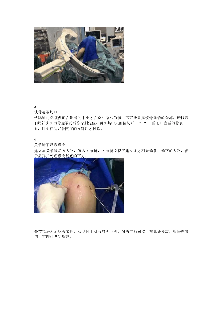 肩锁关节脱位的关节镜下双Endobutton钢板固定技术_第2页