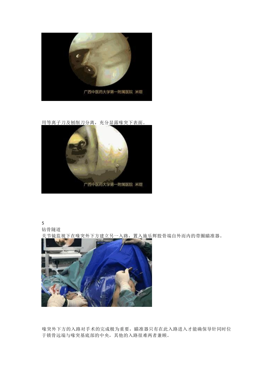 肩锁关节脱位的关节镜下双Endobutton钢板固定技术_第3页