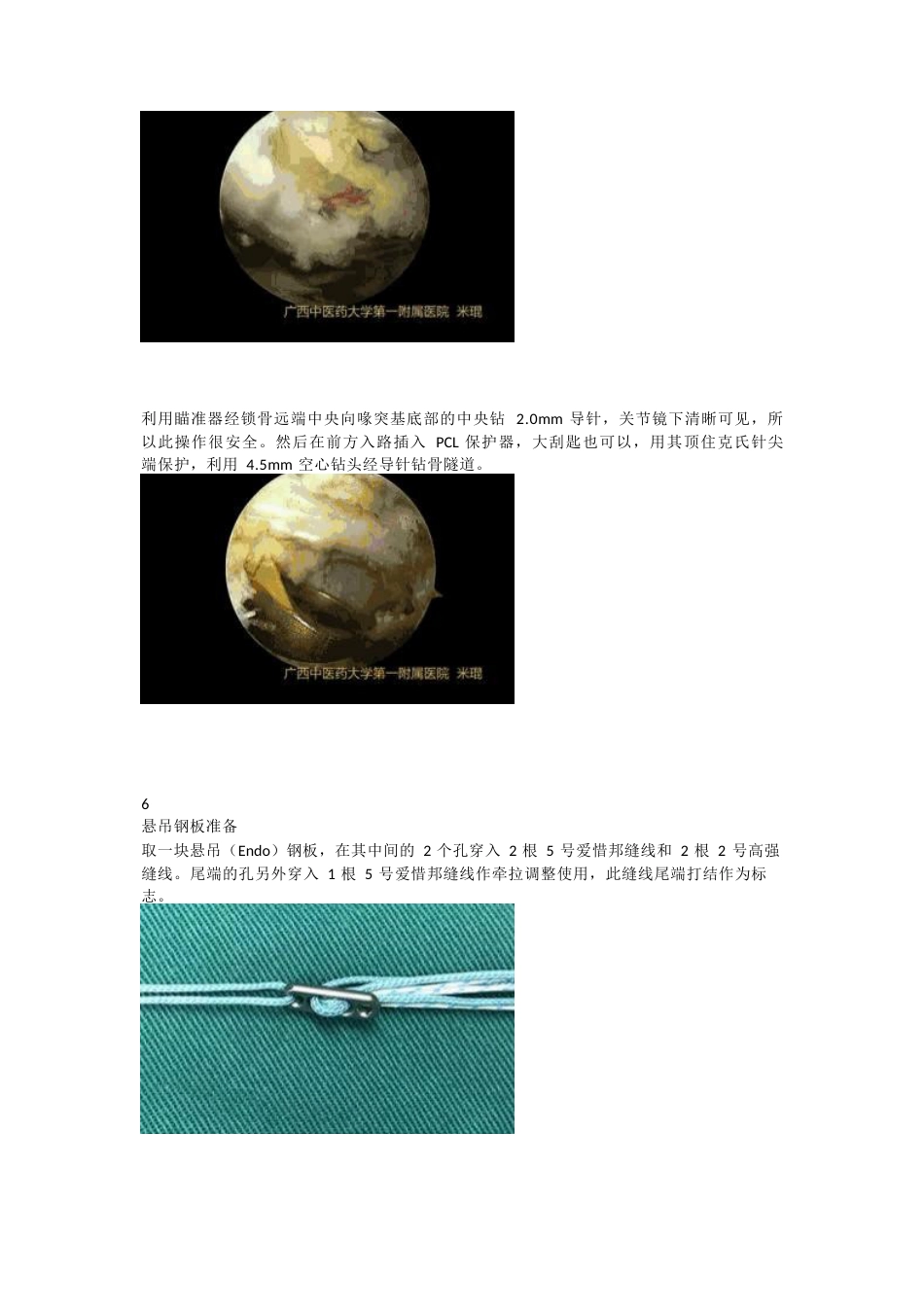 肩锁关节脱位的关节镜下双Endobutton钢板固定技术_第4页