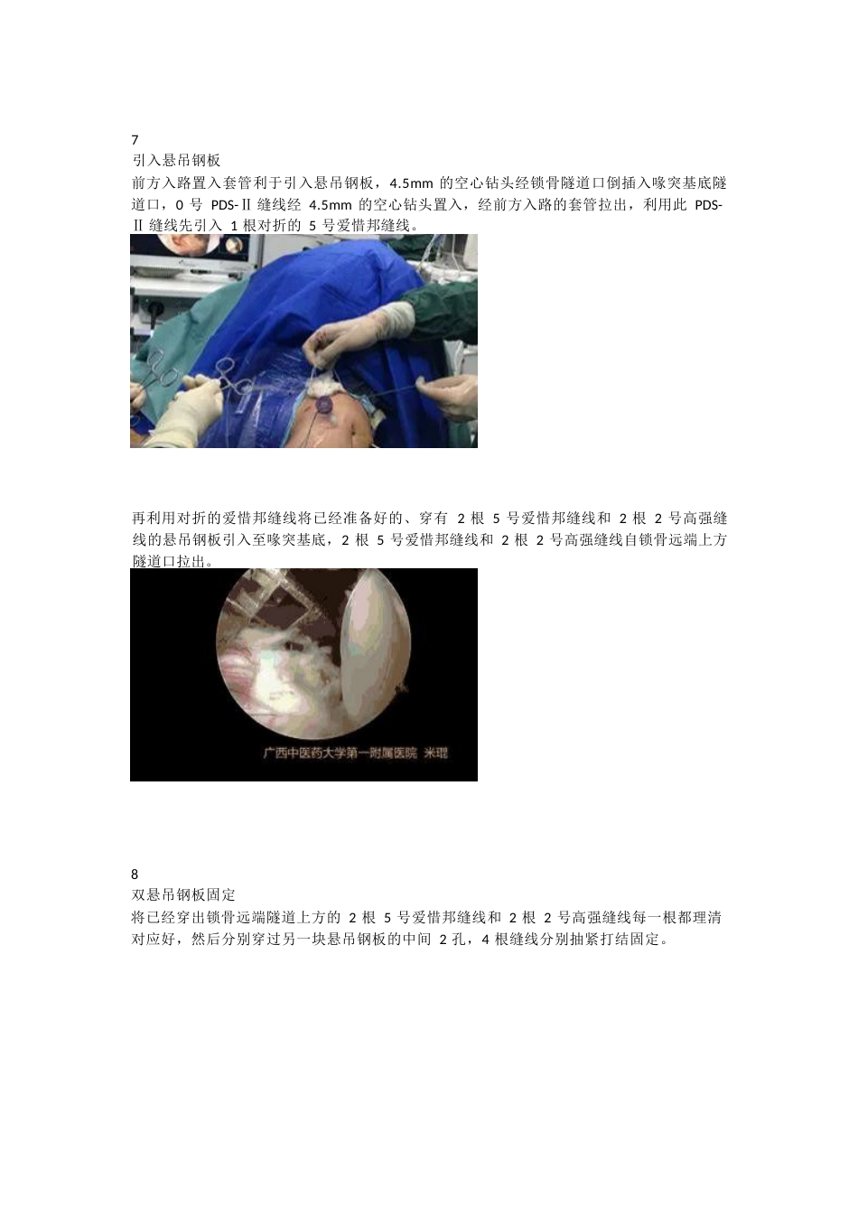 肩锁关节脱位的关节镜下双Endobutton钢板固定技术_第5页
