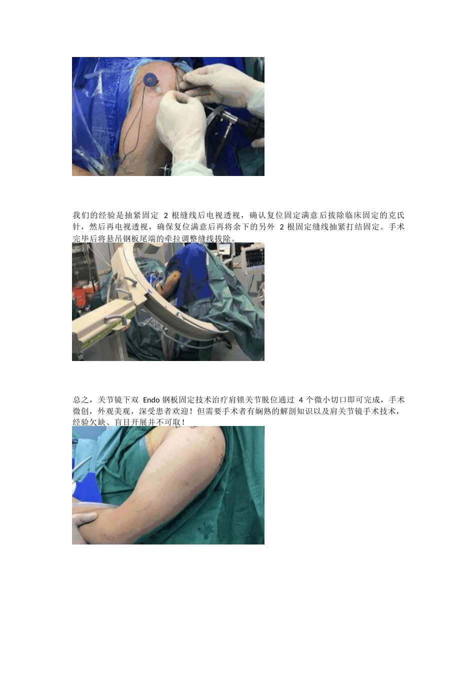肩锁关节脱位的关节镜下双Endobutton钢板固定技术_第6页