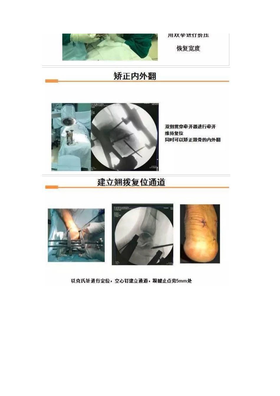 跟骨微创手术的经验与陷阱_第10页