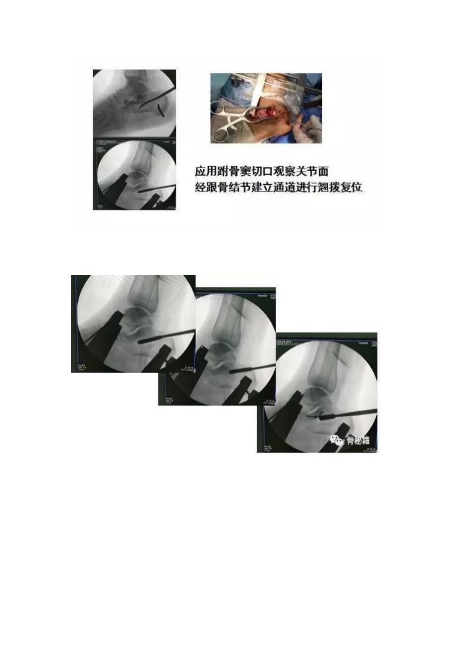 跟骨微创手术的经验与陷阱_第11页