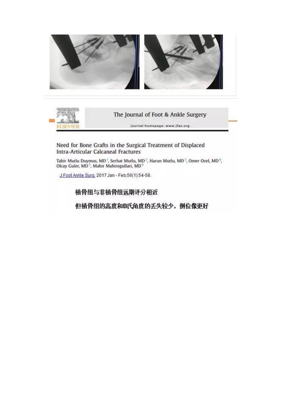 跟骨微创手术的经验与陷阱_第13页