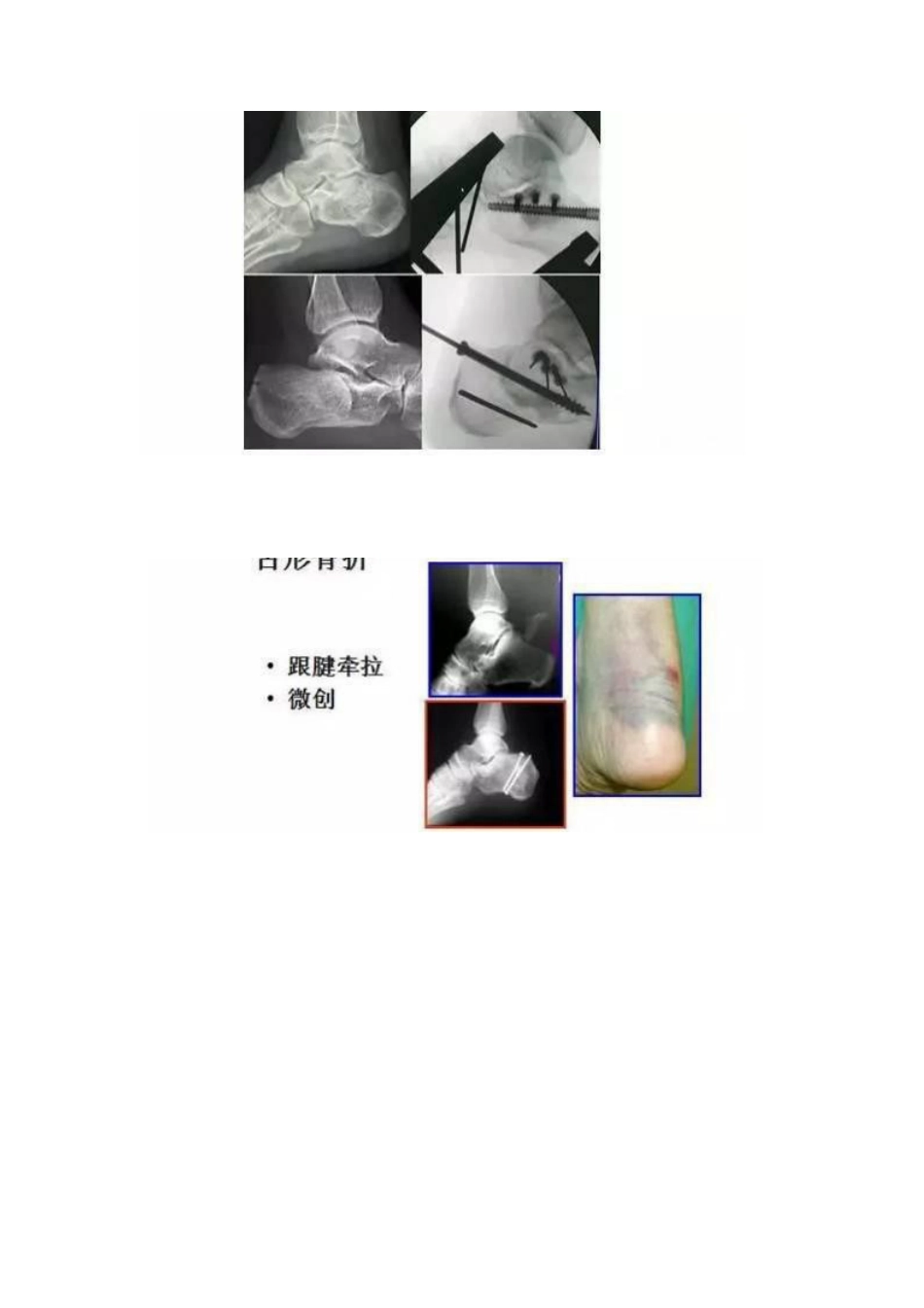 跟骨微创手术的经验与陷阱_第14页