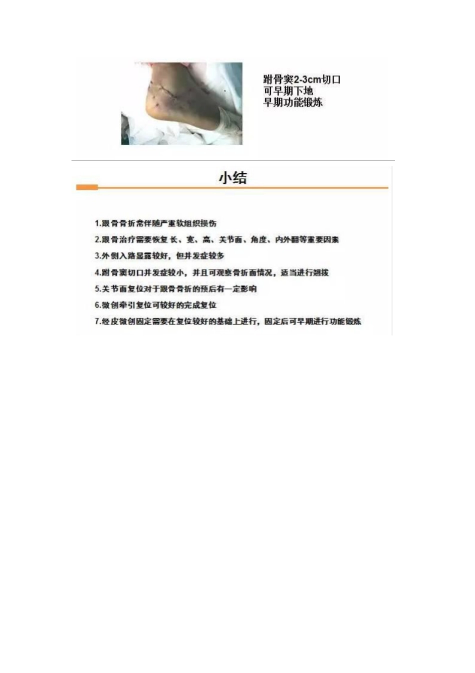 跟骨微创手术的经验与陷阱_第15页