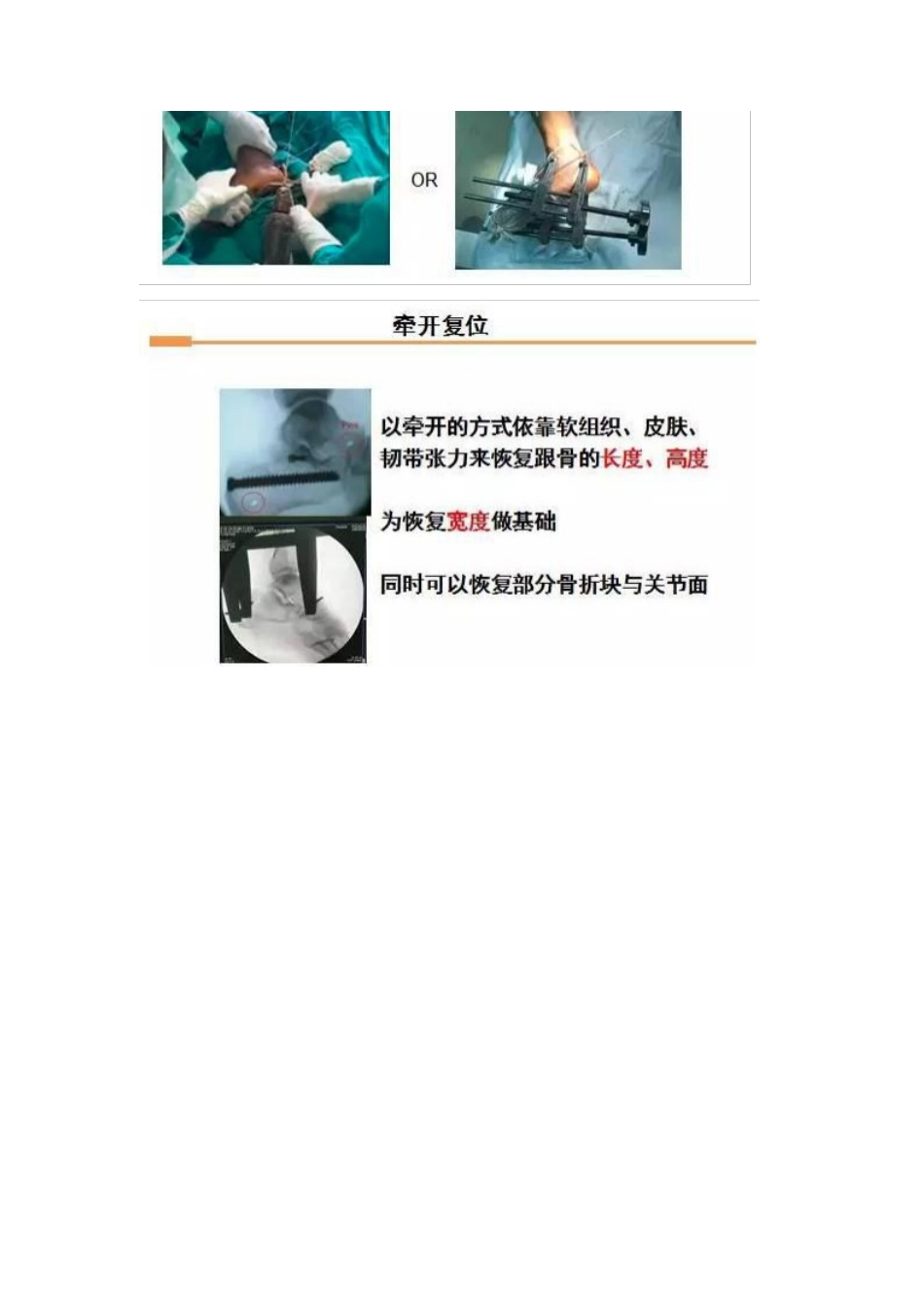 跟骨微创手术的经验与陷阱_第8页